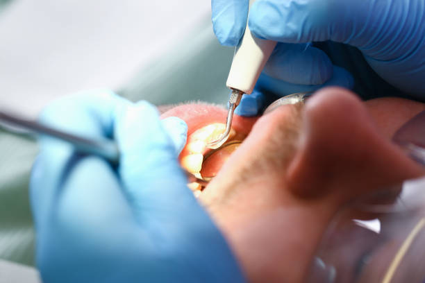 Best Emergency Root Canal Treatment in Hillandale, MD